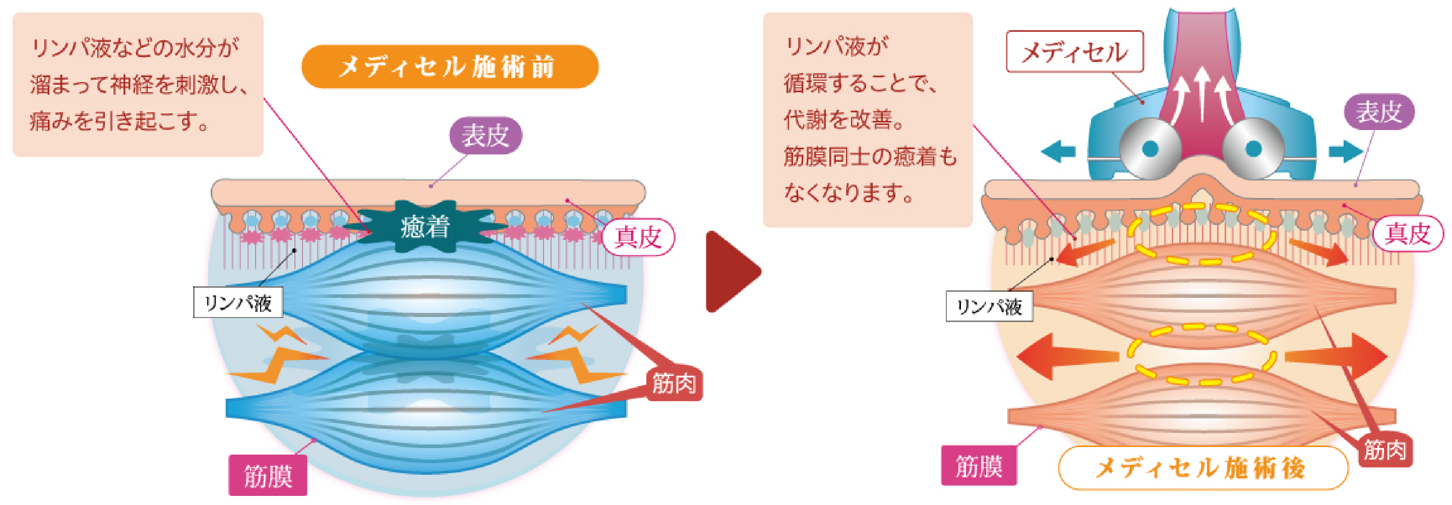 メディセルケアの図解